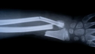 Des scientifiques chinois développent une « colle osseuse » qui guérit les fractures en quelques minutes